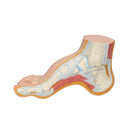 Squelette d'un pied creux (Pes Cavus)